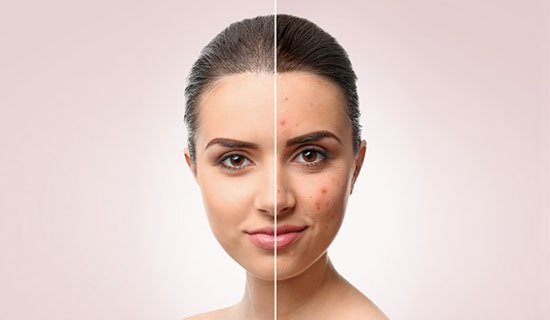 Read more about the article What Causes of Adult Acne & How to Treat It?