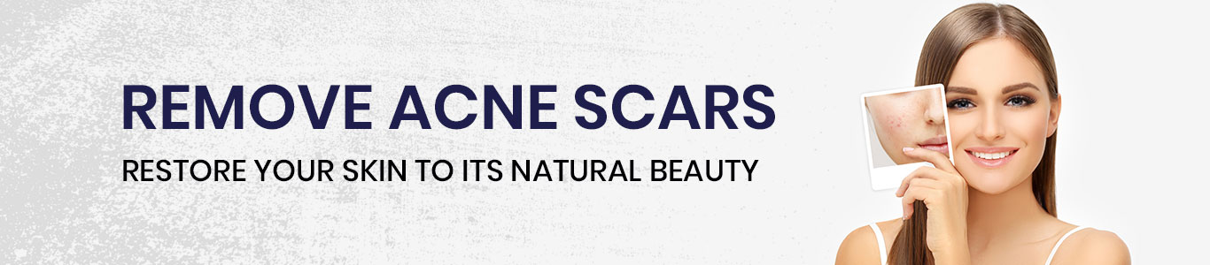 acne-&-acne-scars-treatment-in-hyderabad-skin-care-clinic