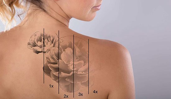 Best Laser Tattoo Removal in Chennai - Soul Skin Clinic