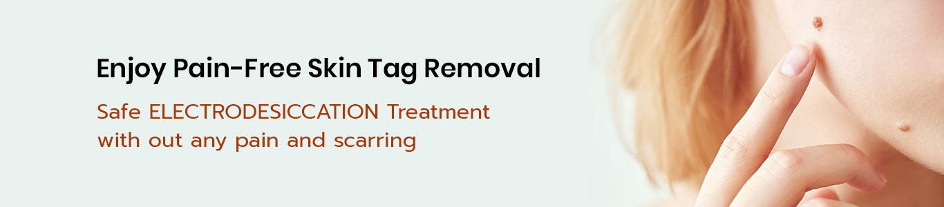 skin-tag-removal-treatment-in-hyderabad-best-skin-clinic-in-hyderabad