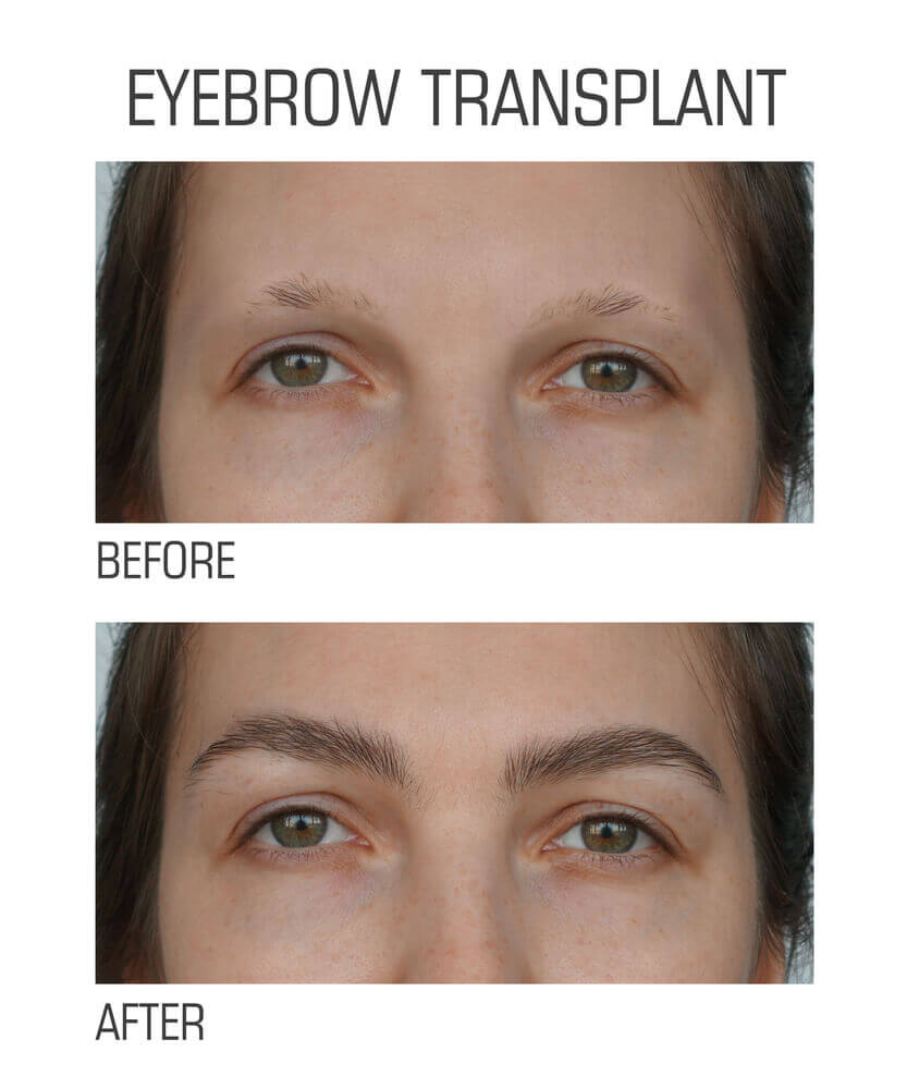 eyebrows-and-beard-hair-transplantation-in-hyderabad