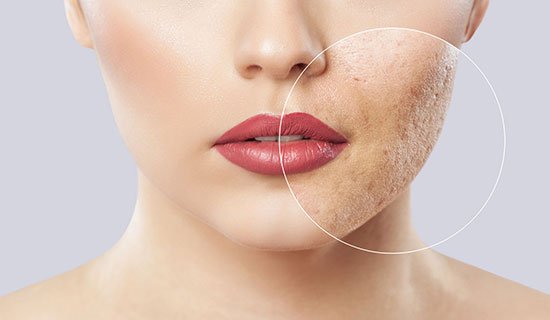 Read more about the article Open Pores Treatment by Skinbliss Clinic in Hyderabad