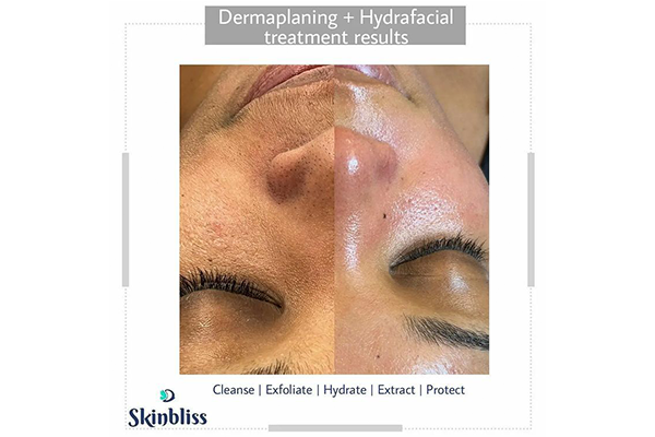 dermal-filler-hyderfacial-treatment-at-skinbliss-clinic-in-hyderabad
