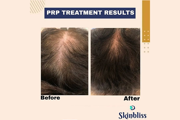 PRP Treatment Result in Hyderabad at Skinbliss Clinic