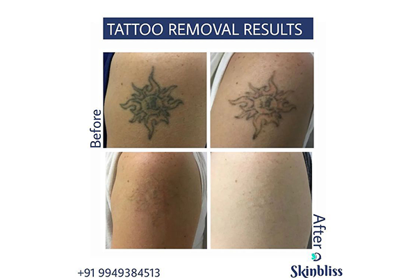 tattoo-removal-result-at-skinbliss-clinic-in Hyderabad