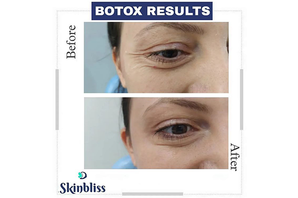 botox-treatment-result-of-skinbliss-clinic-patient