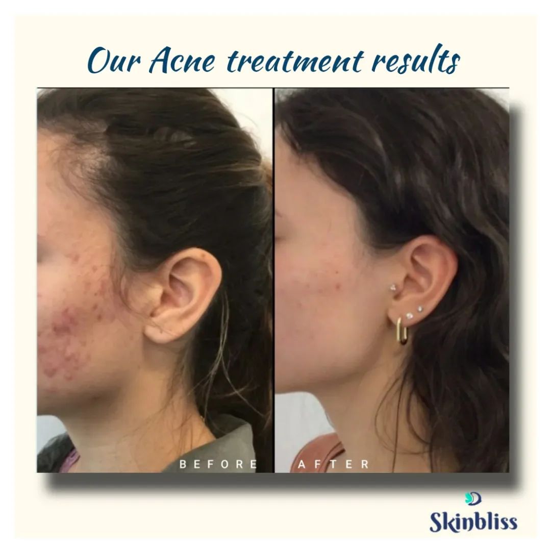 skinbliss-clinic-acne-scars-treatment-results-in-hyderabad