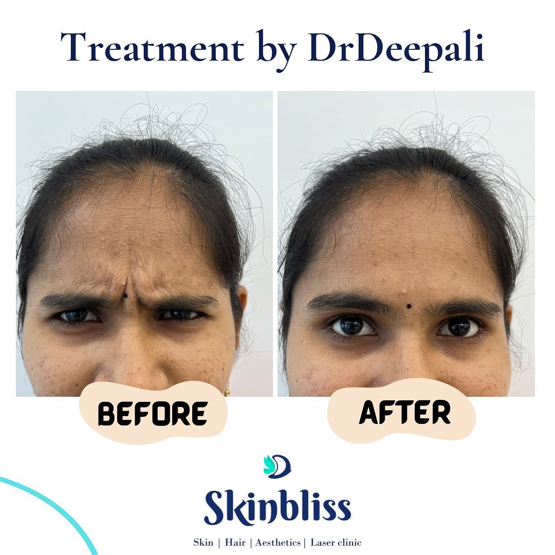 botox-treatment-by-dr-deepali-in-hyderabad-at-skinbliss clinic