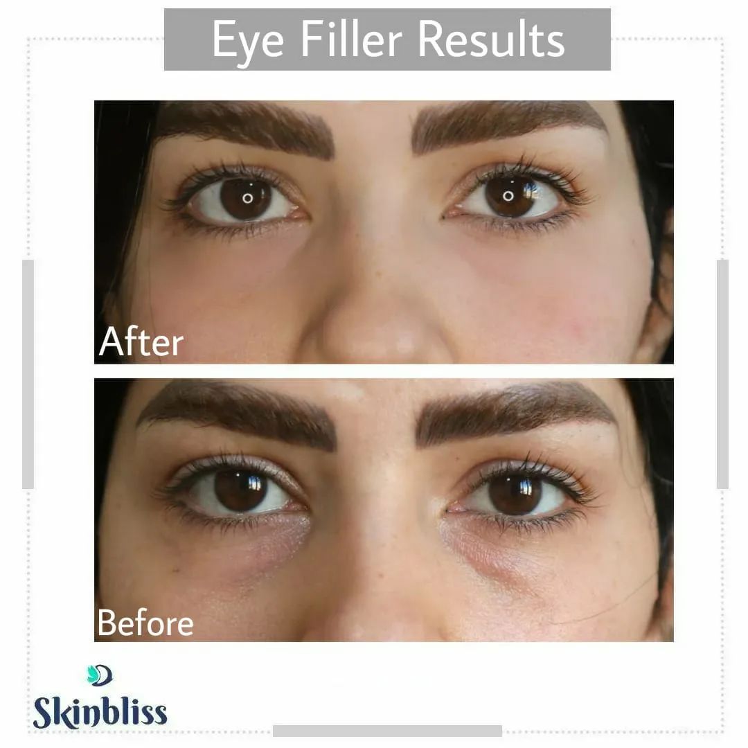 eye-fillers-treatment-in-hyderabad-at-skinbliss-clinic