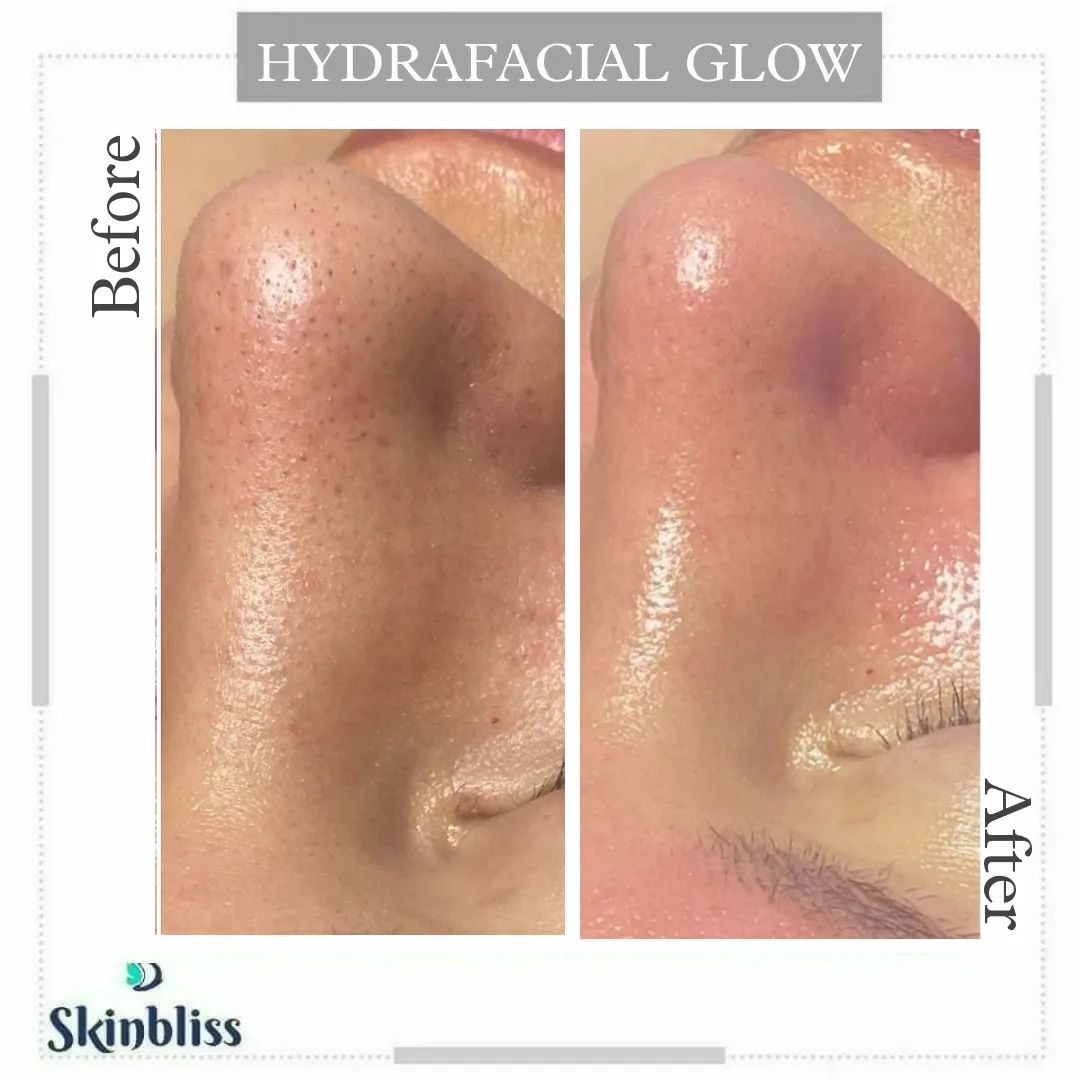 skin-glow-hydrafacial-treatment-in-hyderabad-at-skinbliss-clinic