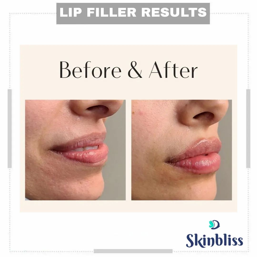 lip-fillers-treatment-in-jubilee-hills-hyderabad