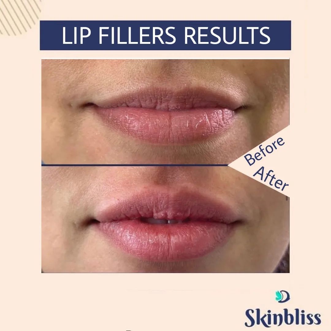 skinbliss-clinic-treatment-lip-fillers-results