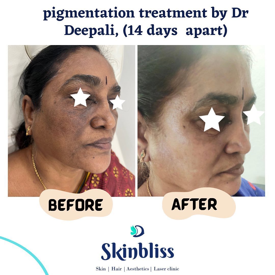pigmentation-treatment-Result-at-skinbliss-clinicin-hyderabad