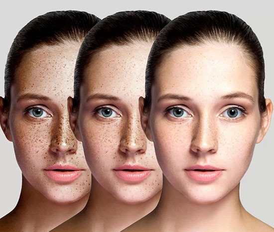 skin-pigmentation-treatment-in-jubilee-hills-hyderabad