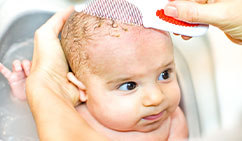 cradle-cap-treatment-at-skinbliss-clinic-in-hyderabad