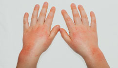 eczema-treatment-at-skinbliss-clinic-in-hyderabad