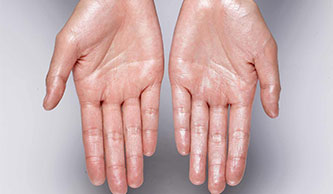 generalized-hyperhidrosis-treatment-at-skinbliss-clinic-in-hyderabad