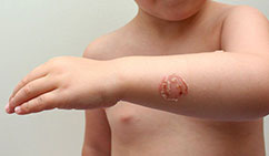 impetigo-treatment-at-skinbliss-clinic-in-hyderabad