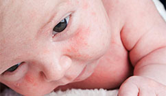 milia-treatment-at-skinbliss-clinic-in-hyderabad