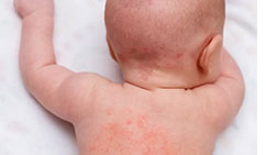miliaria-heat-rash-prickly-heat-treatment-at-skinbliss-clinic-in-hyderabad