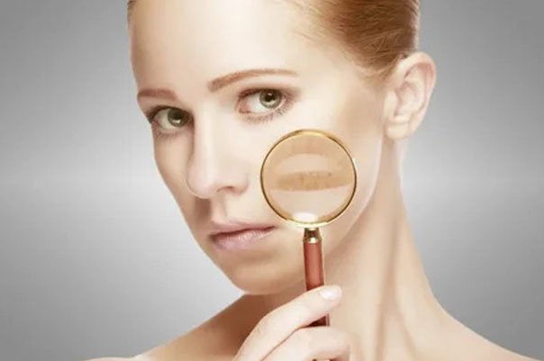 Read more about the article Troubled with Pigmentation on your face Here is the Solution