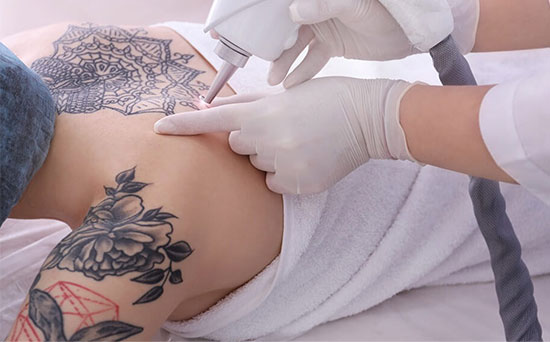 laser-tattoo-removal-in-hyderabad