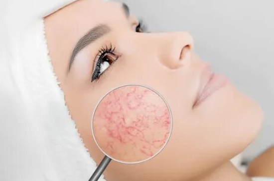 Read more about the article Rosacea Signs and Treatment