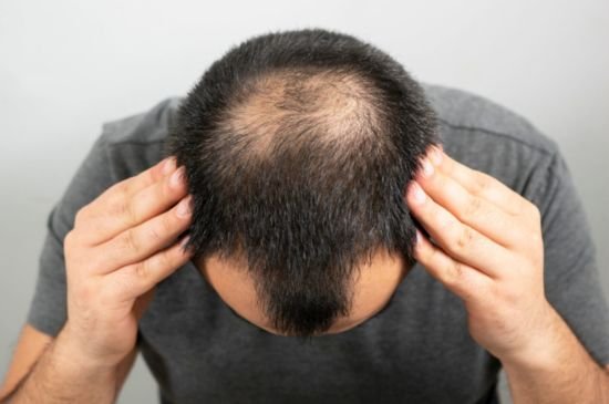 Read more about the article What is Alopecia