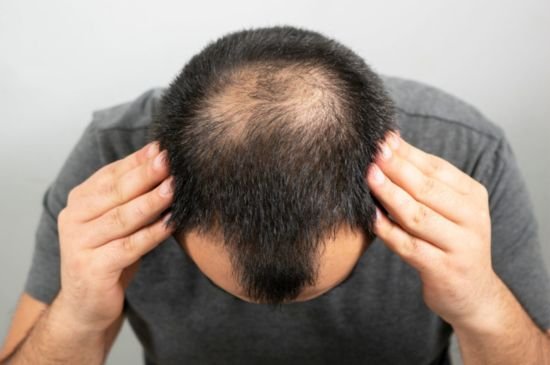 what-is-alopecia