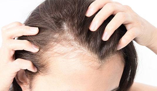Hairloss treatment for alopecia areata