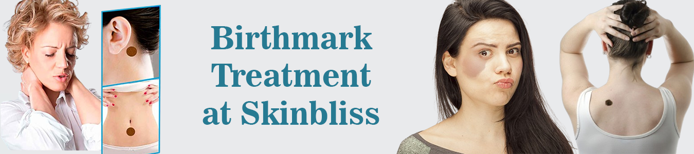 Birthmark-Treatment-at-Skinbliss