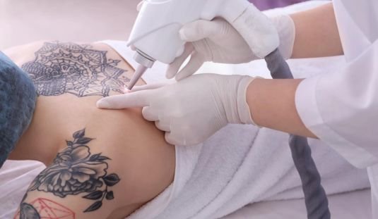 Read more about the article Tattoo removal treatment at skinbliss