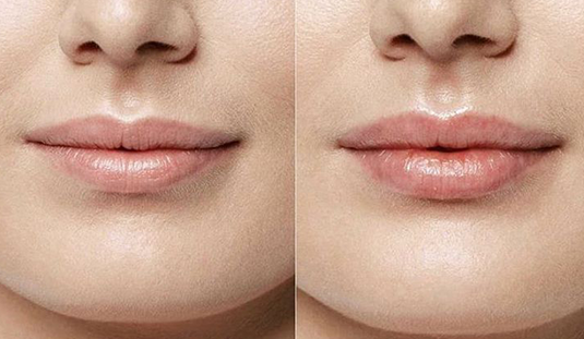 Read more about the article Lip lightening treatment at skinbliss Hyderabad