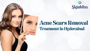 Acne Scars Removal Treatment in Hyderabad