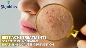 Read more about the article Best Acne Treatments for Teens in Hyderabad: Treatments, Causes and Prevention – Skin Bliss Clinic