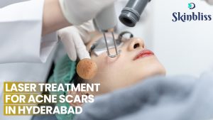 Read more about the article Laser Treatment for Acne Scars in Hyderabad – Skin Bliss Clinic