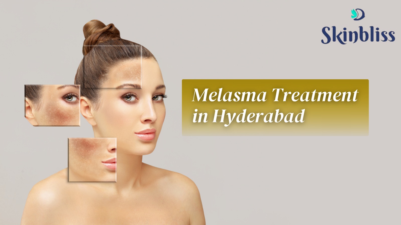 Read more about the article Melasma Treatment in Hyderabad – Skin Bliss Clinic