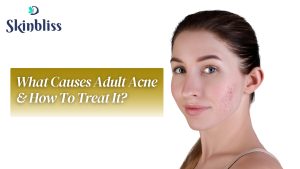 Read more about the article What Causes Adult Acne & How To Treat It? – Skin Bliss Clinic