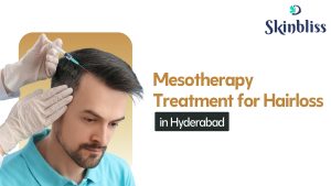 Read more about the article Mesotherapy Treatment for Hair Loss in Hyderabad – Skin Bliss Clinic