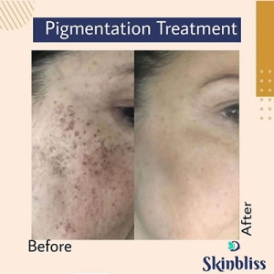best-pigmentation-treatment-clinic-in-hyderabad