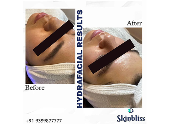 Get Best Hyderafacial Treatment in Hyderabad at Skinbliss Clinic