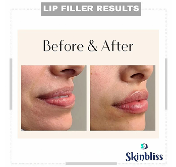 long-lasting-lip-fillers-results-in-hyderabad-at-skinbliss-clinic