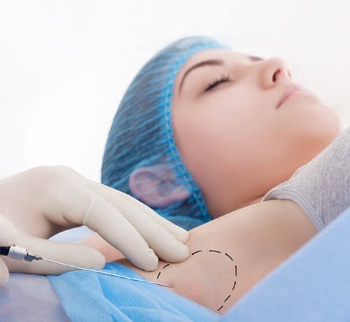 excessive-sweating-treatment-at-skinbliss-in-hyderabad