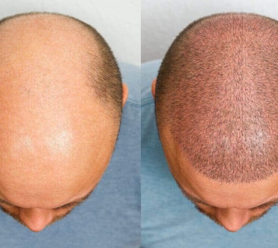 get-hair-transplant-treatment-at-skinbliss-clinic-in-hyderabad