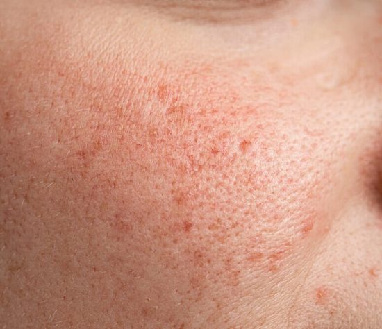 open-pores-treatment-at-skinbliss-in-hyderabad
