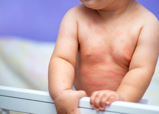 child-to-a-pediatric-dermatologist-in-hyderabad