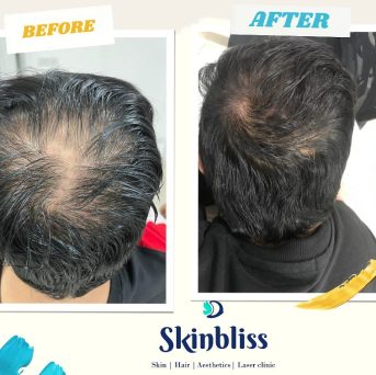 scalp-micropigmentation-treatment-result-at-skinbliss-clinic