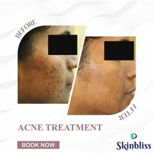 after-and-before-acne-treatment-result-in-hyderabad-at-skinbliss-clinic