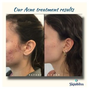 skinbliss-clinic-acne-treatment-results-in-hyderabad
