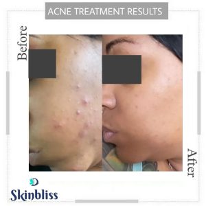 after-and-before-acne-treatment-result-at-skinbliss-clinic